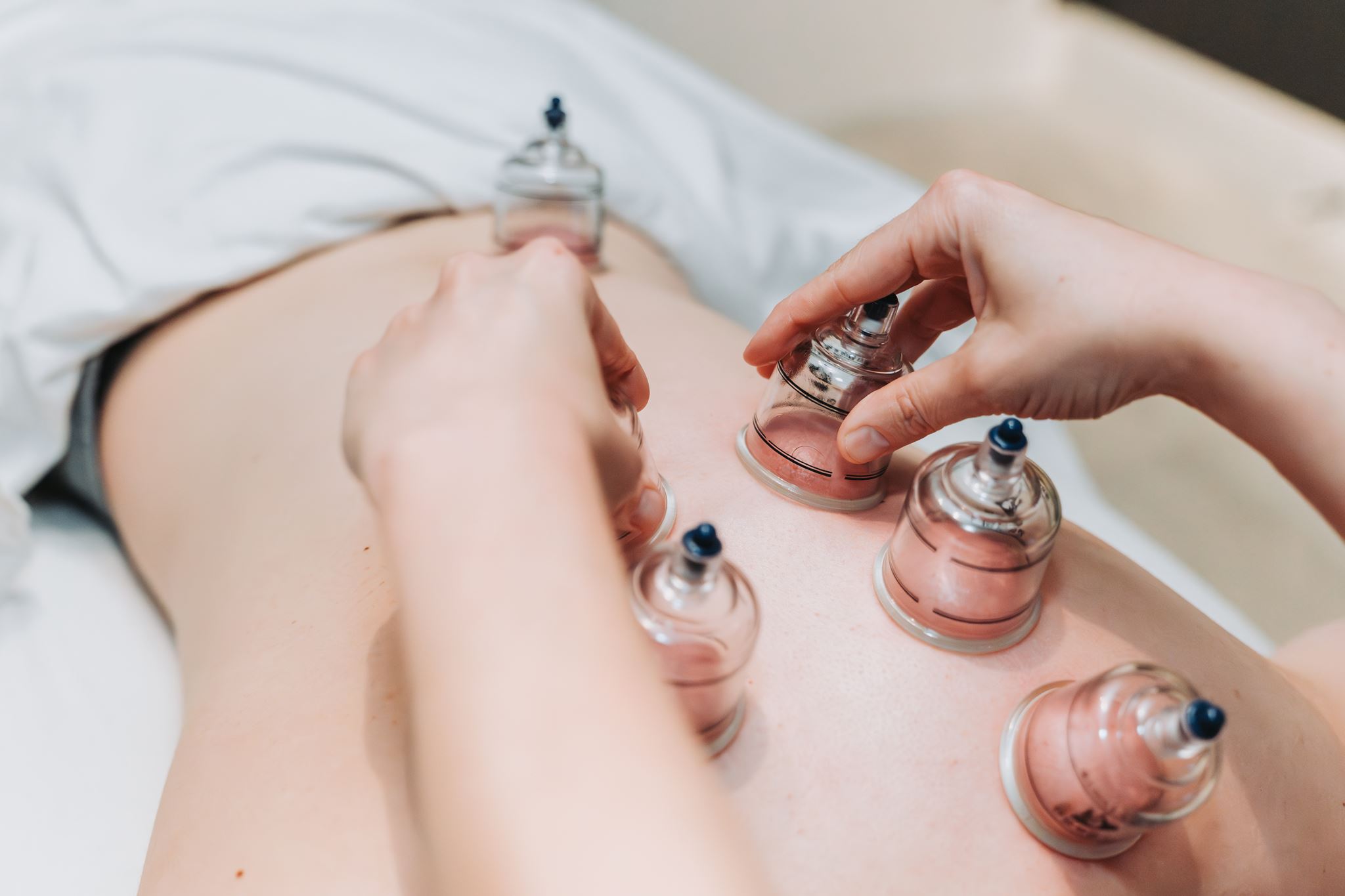 Cupping therapy session at MYO Massage Therapy Clinic